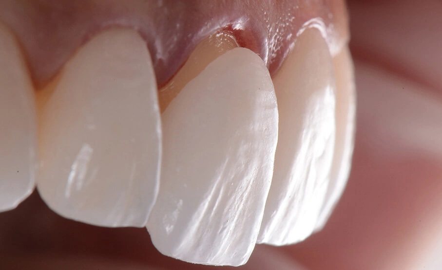 عوارض کامپوزیت دندان